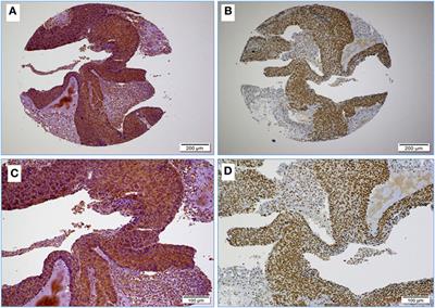 Co-Incidence of Epstein–Barr Virus and High-Risk Human Papillomaviruses in Cervical Cancer of Syrian Women